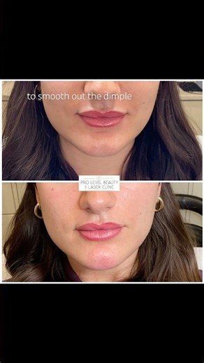 Can you smooth a dimple?