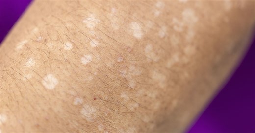 Notice these small white spots on your arms or legs? Most people have no idea what they mean. Don't ignore this!