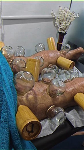 Cupping is an excellent form of preventive & curative therapy #acupuncture#hijama#massage#reels