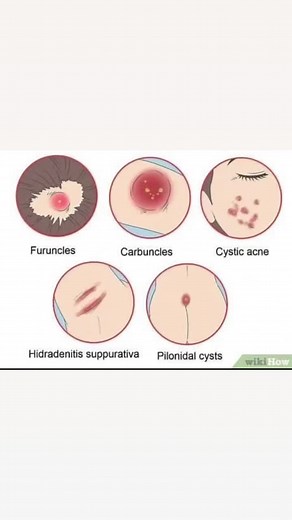 There are different types of boils, or superficial skin infections. These are: Carbuncle: A carbuncle is an abscess in the skin caused by the bacterium Staphylococcus aureus. It is present as a cluster of boils. Hidradenitissuppurativa: a skin condition in which a group of abscesses occur in the armpits, buttocks and groin area due to local inflammation of apocrine glands. Pilonidal cyst: an abscess that occurs on or above the cleft of the buttocks. Cystic acne: larger pimples that occurs when o