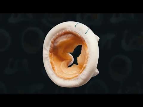 TAVR Valve-in-Valve Procedure: Treating Failing Surgical Heart Valves