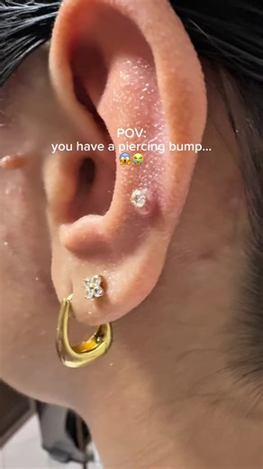 Homemade Saline Solution for Piercing Bumps