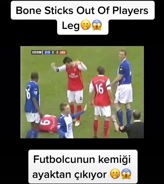 Terrifying Football Injury: Bone Sticks Out Of Player's Leg