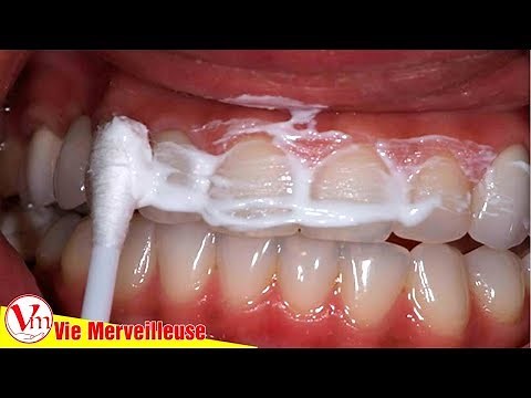 Whiten Teeth in 3 Minutes | Here's How to Make the Magic Paste to Revive Your Smile