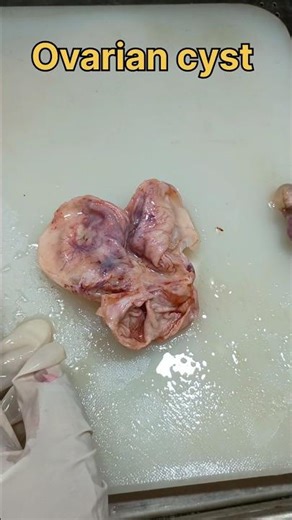 Ovarian cyst specimen for examination| #histopathology #ovariancyst #cyst #gynecologicpathology