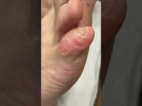 Watch This Podiatrist Remove a Corn: Expert Foot Care Tips #Podiatry #FootHealth