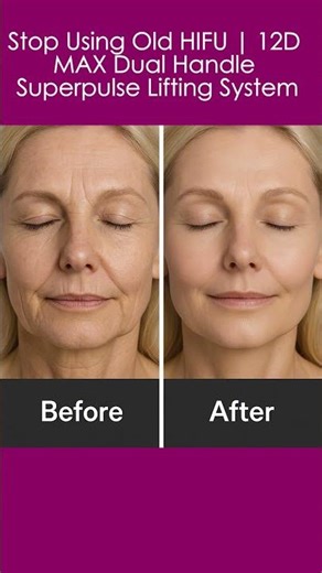 Advanced 12D MAX HIFU | Dual Handle Superpulse Face & Body Lifting