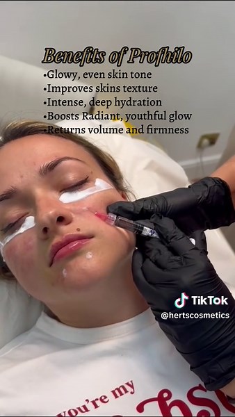 Let’s Talk Profhilo 💉 Profhilo is a pure hyaluronic acid injectable that hydrates from within, firms the skin, and stimulates collagen & elastin — leaving your skin smoother, tighter, and more radiant. It’s injected using a 5-point technique on each side of the face, allowing it to spread evenly, naturally for a full-face rejuvenation. 📆 Best results seen after 2 sessions, 2 weeks apart. ⏱️ Results lasting up to 6 months. 📍 The Maltings, SG12 8HG 🔗 Book using link in bio #hertsenhance #profh
