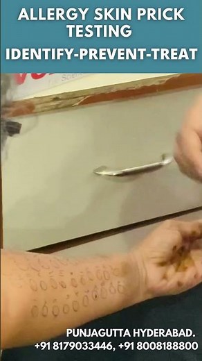 Skin Prick Test | SPT | Allergy Test | Skin Prick Allergy Test | Dr. Chava Anjaneyulu ENT Specialist