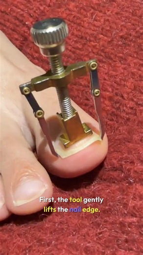 Nail Art on Instagram: "This demo shows a full ingrown toenail correction system. First, the tool gently lifts the nail edge. Corrector strips hold the new shape in place. Patches protect the surface and reduce pressure. Together, they guide the nail to grow outward instead of inward."