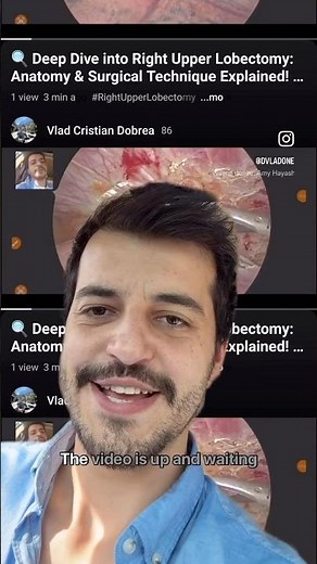 🔍 Deep Dive into Right Upper Lobectomy: Anatomy & Surgical Technique Explained! 🩺💡