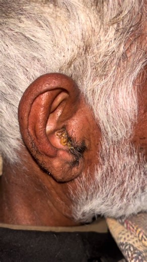 Ear Cleaning Process Explained for Seniors