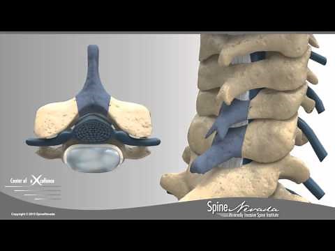 Posterior Cervical Laminectomy & Fusion at Swift Institute, Reno, Sparks, Carson City