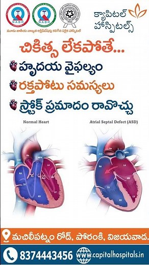Understanding Atrial Septal Defect (ASD) | Capital Hospital Vijayawada