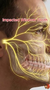 2.8K reactions · 389 shares | Watch the precision required to avoid the nerve! 醴✨ This 3D animation shows the surgical extraction of an impacted wisdom tooth. 1️⃣ Incision 2️⃣ Odontosection (Cutting the tooth) 3️⃣ Safe Removal 4️⃣ Sutures Question: Do you still have your wisdom teeth? Tell me in the comments!  #wisdomteeth #dentist #oralsurgery #satisfying #asmr | Dr. Carienator | Facebook