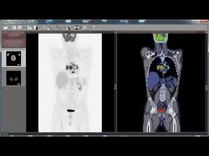 RadiAnt DICOM Viewer PET-CT fusion preview