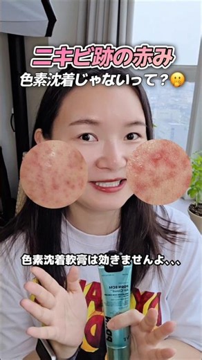 How to Fix Red Acne Marks #AcneMarks #AcneCare