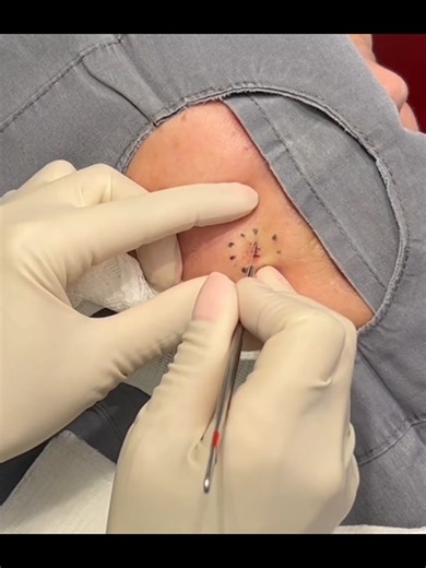 PERFECTLY PILAR CYST! Watch more on Dr. Pimple Popper Youtube Channel! DISCLAIMER: All procedures shown are performed in a medical office by a licensed, board- certified dermatologist. Always consult a professional for skin concerns. #drpimplepopper #popaholics #pops