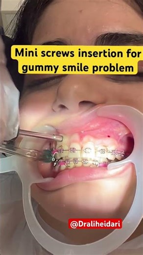 Gummy smile problem treated by mini screws insertion,step by step protocols .By Dr Ali Heidari