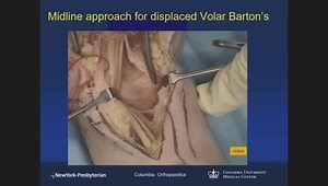 Distal Radius Fracture