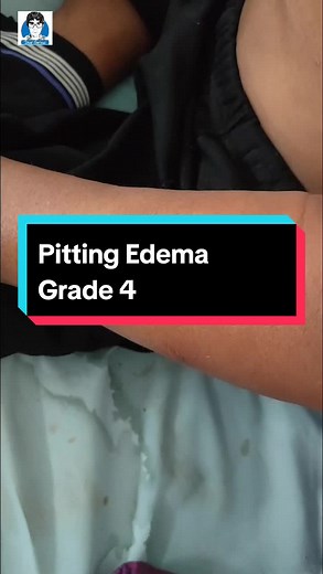Pitting Edema: Memahami Derajat dan Gejalanya