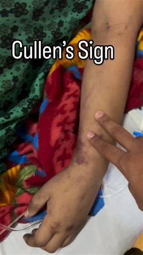 MEDICINE_1O1 on Instagram: "Cullen’s Sign — periumbilical ecchymosis due to retroperitoneal bleeding. It occurs when pancreatic enzymes (especially in acute pancreatitis) cause fat necrosis and vessel erosion, allowing blood to track through fascial planes to the umbilicus. Cullen’s Sign often appears 24–48 hours after the onset of bleeding, so its presence usually indicates severe or delayed pathology. #neetpg #inicet #mbbs #medicine #fmge #doctor #studygram #medicos #usmle #studynotes"