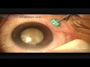 Phacoemulsification in shallow anterior chamber | Dr.Moataz Wessam