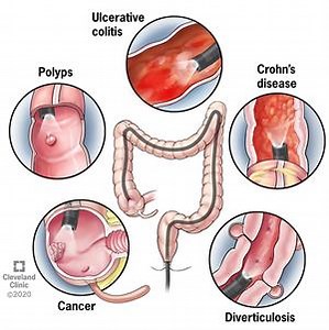What exactly happens during a colonoscopy? [2025] | QAQooking.wiki