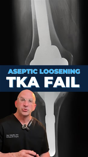 Cory Calendine MD on Instagram: "🦿TKA Aseptic Loosening is an inflammatory response that results in bone loss > implant loosening. Diagnosis is made w/ knee x-rays. . Steps in process of #AsepticLoosening: small particle debris formation > inflammatory response > osteolysis > implant micromotion/loosening (implant-cement interface is most common “weak link” vs bone-cement interface) . TKA Aseptic Loosening X-ray Findings: - tibia osteolysis (bone breakdown) - femoral #osteolysis - radiolucent a