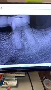 No cbct. POV clinical video of root canal therapy of this completely calcified tooth 19. #rct #rootcanal #rootcanaltherapy #dentistry #dentalschool | Advanced Micro-Endodontics