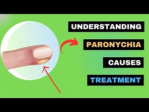 Paronychia Explained: How to Spot, Treat, and Prevent Nail Infections | SWOLLEN TISSUE around Nails