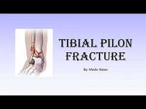 Tibial pilon fracture - clinical feature, Ruedi & Allgower classification, investigation, treatment