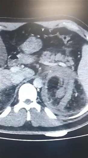 angiomyolipoma versus retroperitoneal liposarcoma. #توعية_طبية #emergencyroom