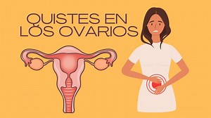 Qué son los quistes en los ovarios Los quistes en los ovarios son sacos llenos de líquido que se forman dentro o sobre la superficie de uno o ambos ovarios en las mujeres. Son comunes y a menudo son benignos, lo que significa que no son cancerosos. Los quistes pueden variar en tamaño, desde tan pequeños como una semilla de amapola hasta tan grandes como una pelota de golf. Muchas mujeres pueden tener quistes en los ovarios en algún momento de su vida sin siquiera saberlo, ya que a menudo no caus