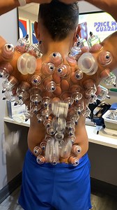 1.6M views · 517 reactions | Cupping therapy uses suction to lift and decompress layers of fascia and muscle, helping improve blood flow, reduce stiffness, and ease deep muscle tension. Great for recovery and stress relief—sometimes you need to pull to release. #CuppingTherapy #MyofascialRelease #ChicagoChiropractic #ChiropracticCare #drkyleross | Dr_kyleross | Facebook