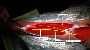 M - Conventional open harvesting of the radial artery as a conduit for coronary artery bypass grafting