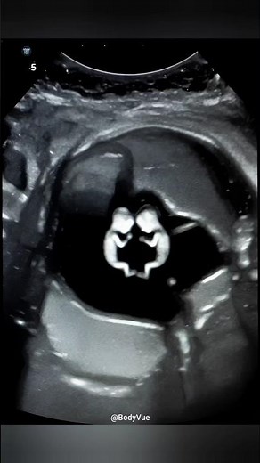 Twins at 5 Weeks Ultrasound 3D Scan #pregnancy #twinpregnancy #twinhealth