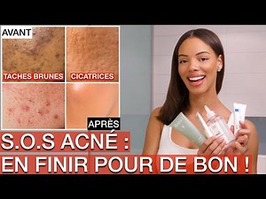 Comment éliminer les Boutons, Cicatrices, Taches..| Routine Efficace contre l'Acné !