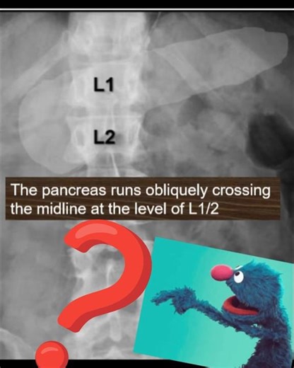 Pancreatic calcifications