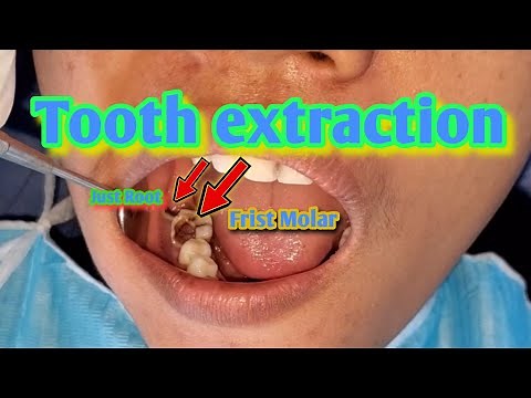Tooth extraction # 1 Molar and just root ( TEETH SMILE RESTORATION )