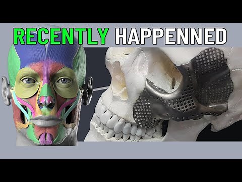 Shocking Breakthrough 3D Printed Artificial Bones Implanted In Human Body