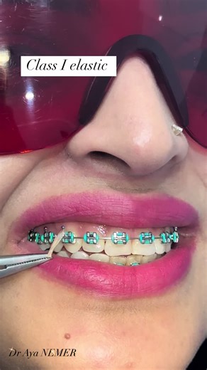 Class I elastic used to correct the bite #ortho #orthodontic #alain #abudhabi #dubai #photography #drayanemer