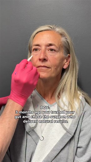 Laura (56) talked to several talented surgeons before she chose me. She left each consult thinking, “This just isn’t for me.” She just didn’t resonate, something didn’t feel right. One surgeon recommended removing a large section of skin on her forehead with her take home message that it would leave her permanently numb 😳 Eventually, she found me, and unbeknownst to me at the time, she had a completely different interaction than what she had experienced in the past. 🤗 Flash forward, and here w
