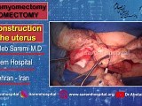 Adenomyomectomy • Video • MEDtube.net