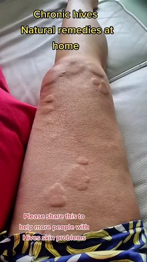 Natural Home Remedies for Hives Relief