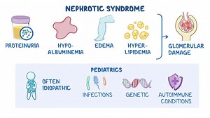 Video: Nephrotic syndromes (pediatrics): Clinical sciences - Video Explanation! | Osmosis | Osmosis