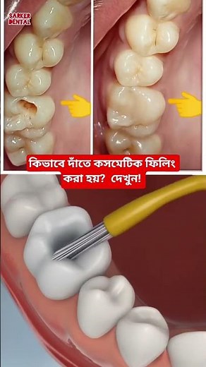 How to fill teeth, Tooth cavity removal and filling #dentist