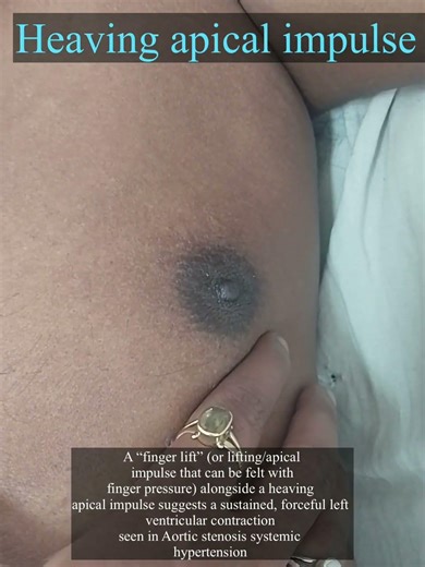 Heaving apical impulse