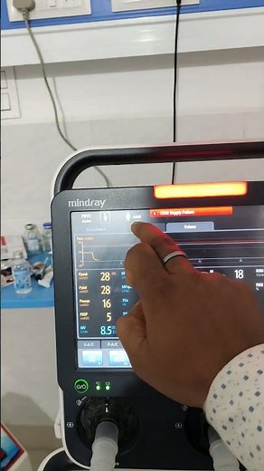 ‪@mindray_india‬ mindray SV300 ventilator