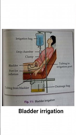bladder irrigation#important procedure of fundamental nursing#
